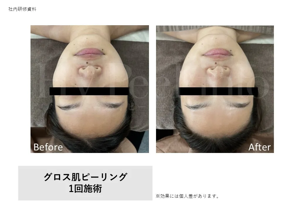 グロス肌ピーリング