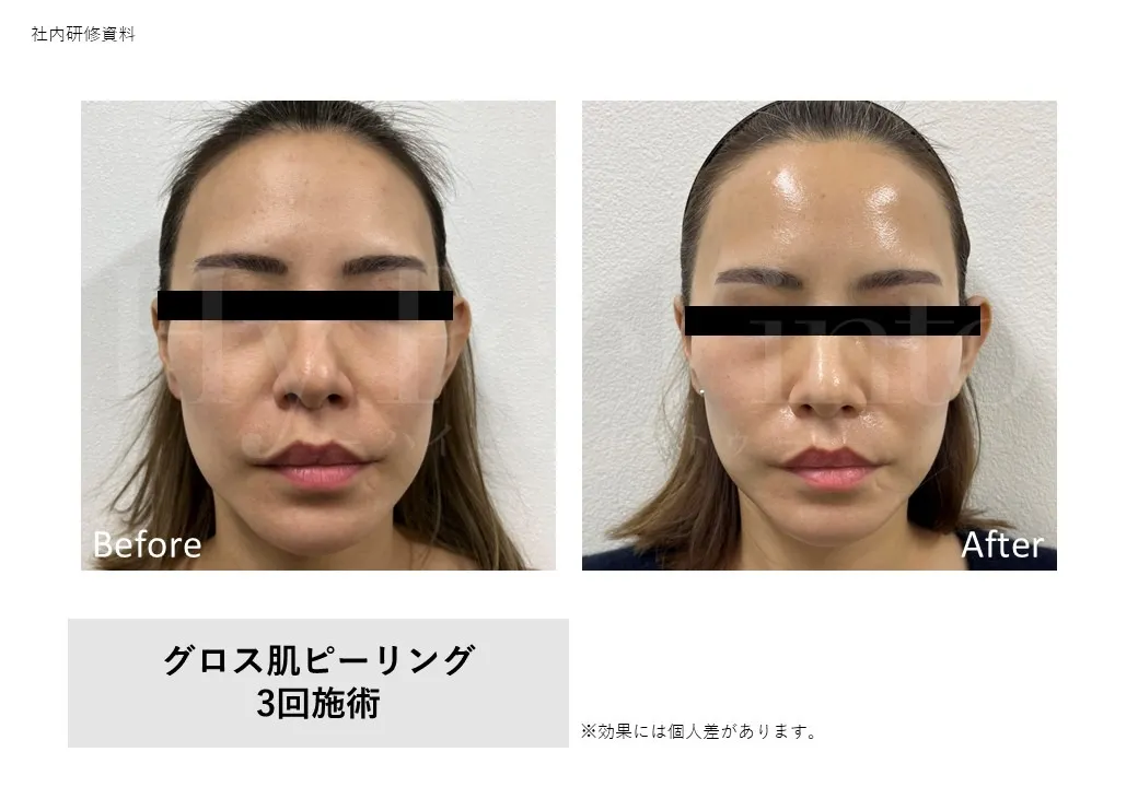 グロス肌ピーリング