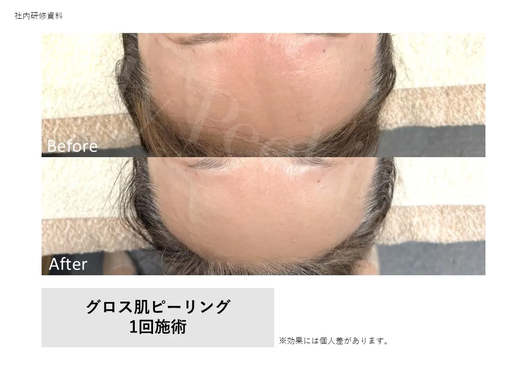 グロス肌ピーリング