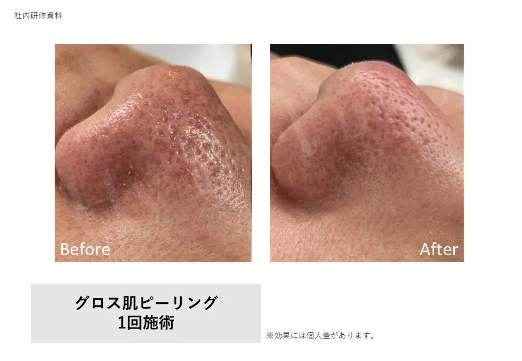 グロス肌ピーリング