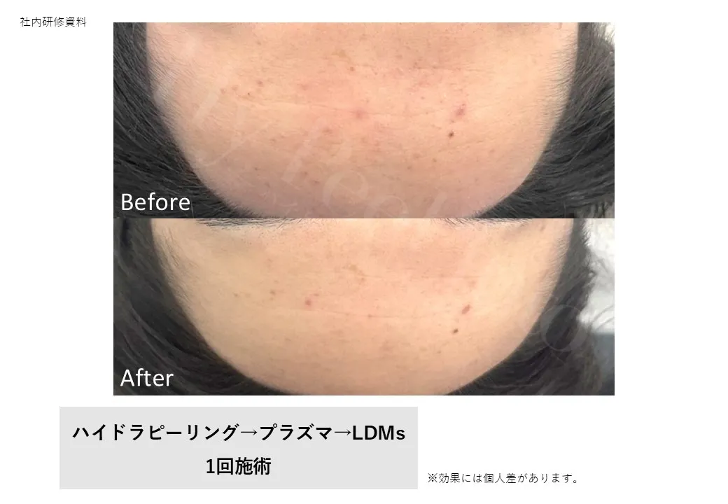 ハイドラ・プラズマ・LDMs