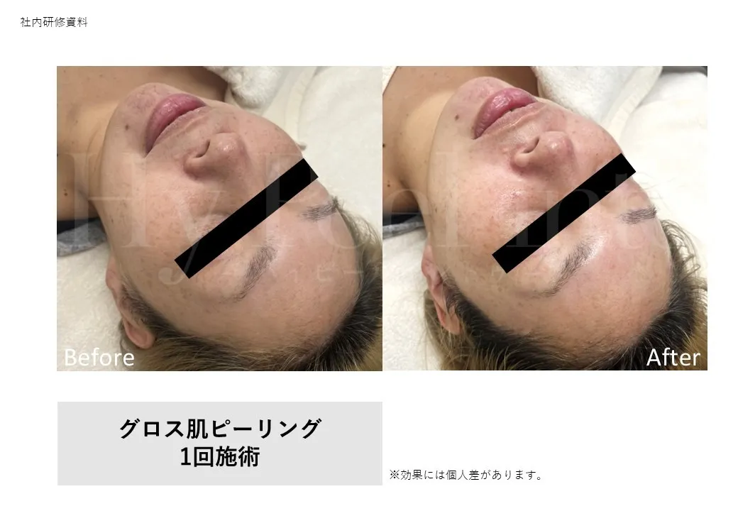 グロス肌ピーリング