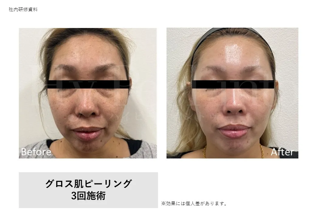 グロス肌ピーリング