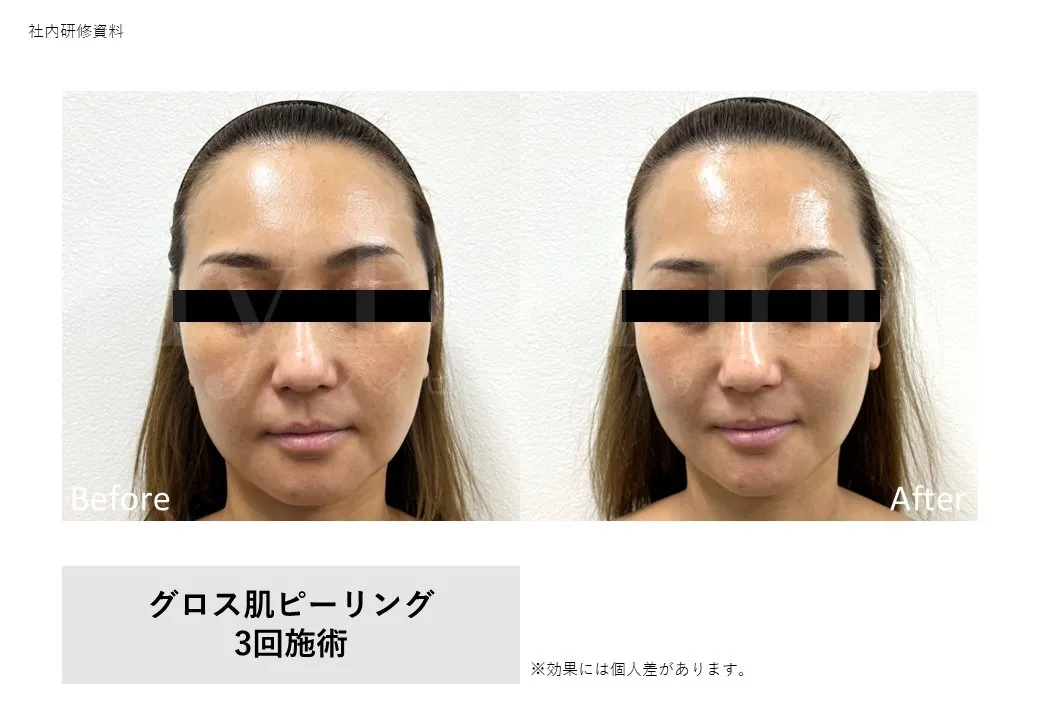 グロス肌ピーリング